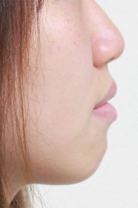 戽斗病例-010