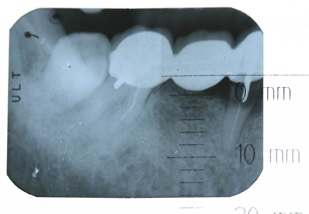 Implant-1-001