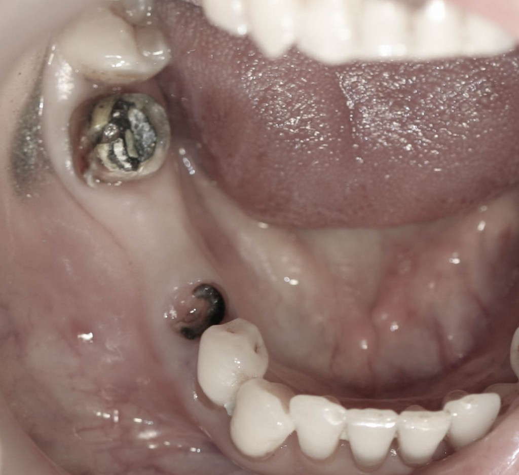 Implant-1-002