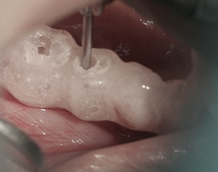 Implant-1-004