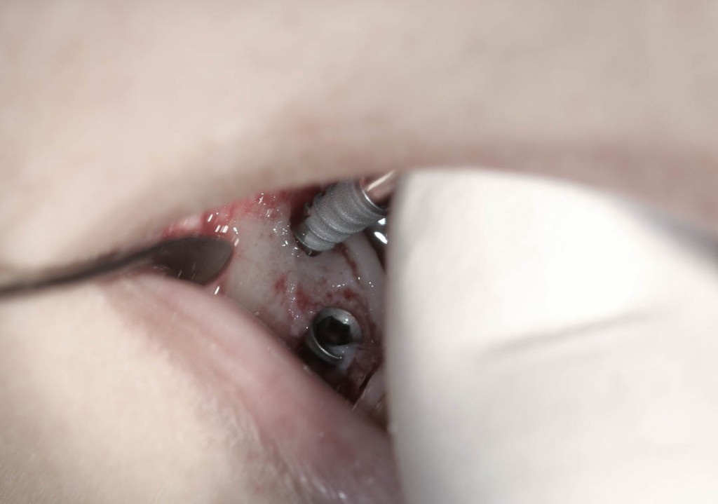 Implant-1-008