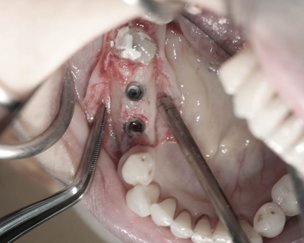 Implant-1-009