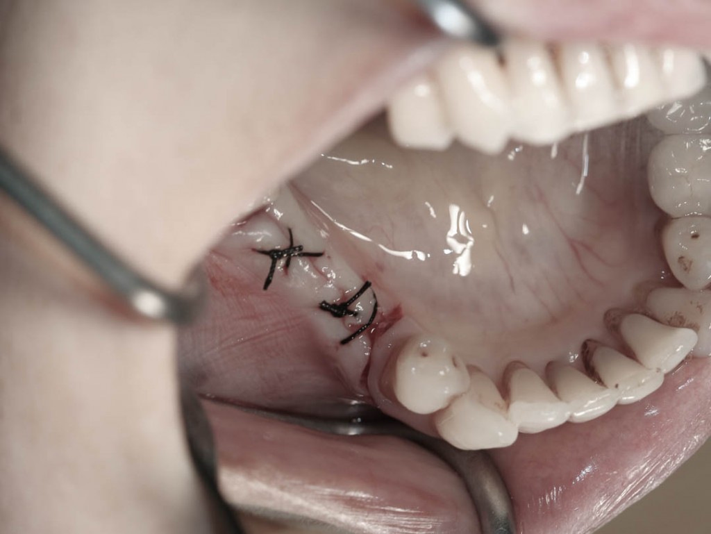 Implant-1-010