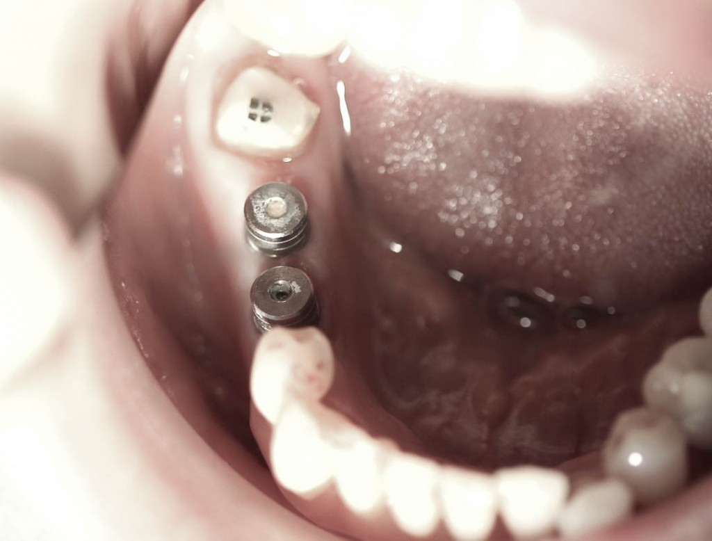 Implant-1-011