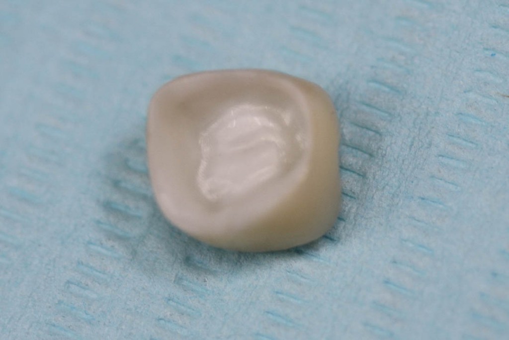 Implant-1-012