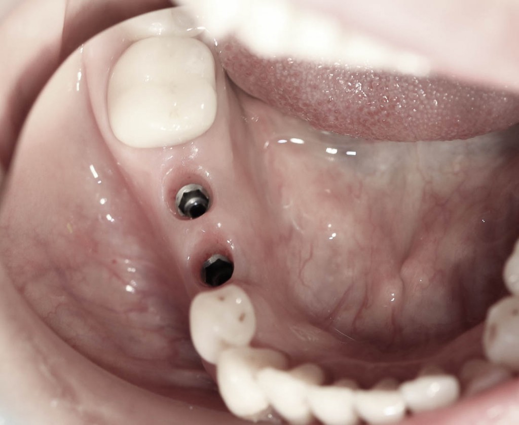 Implant-1-013