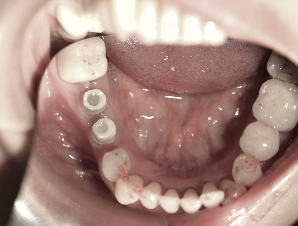Implant-1-014