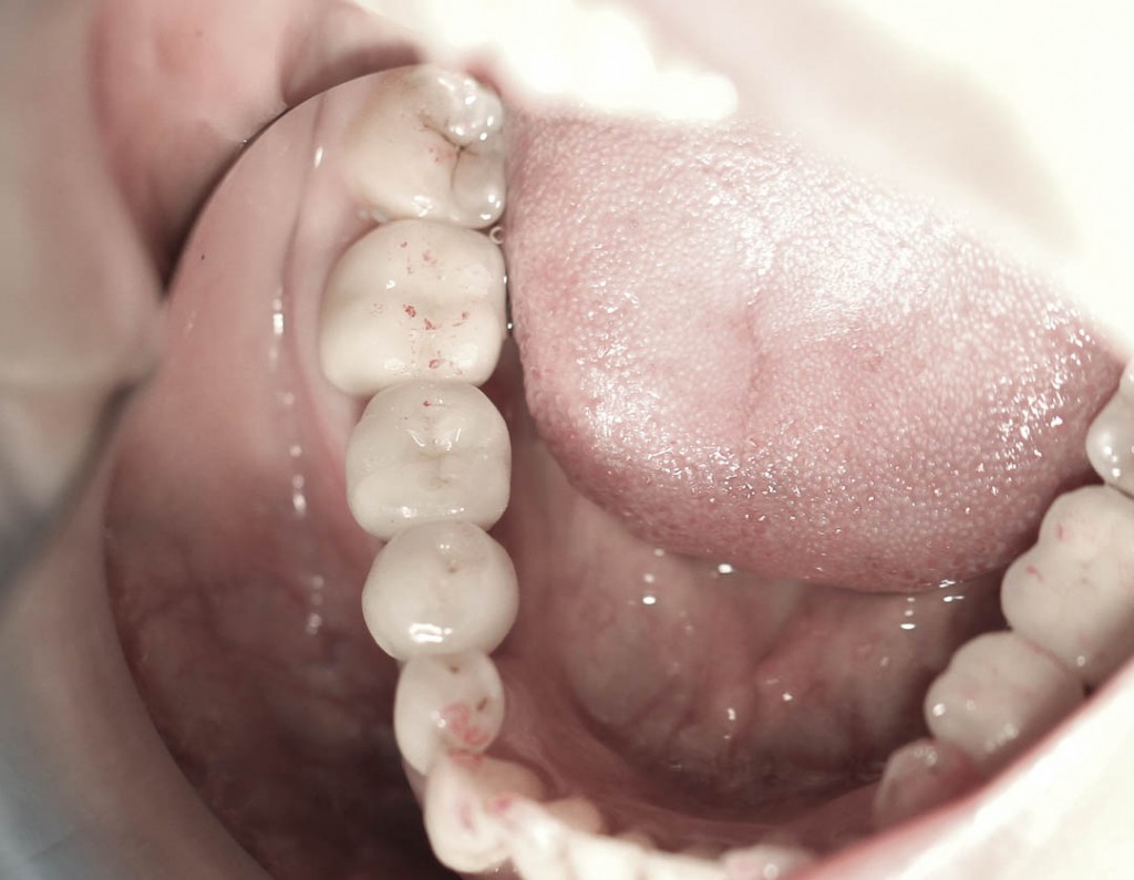 Implant-1-016