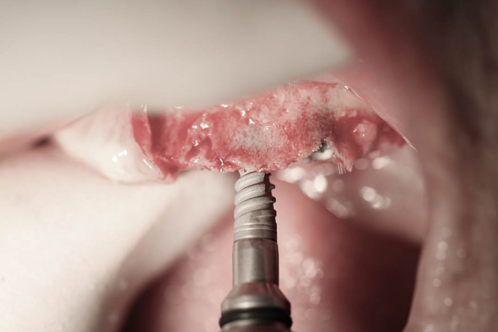 Implant-2-008