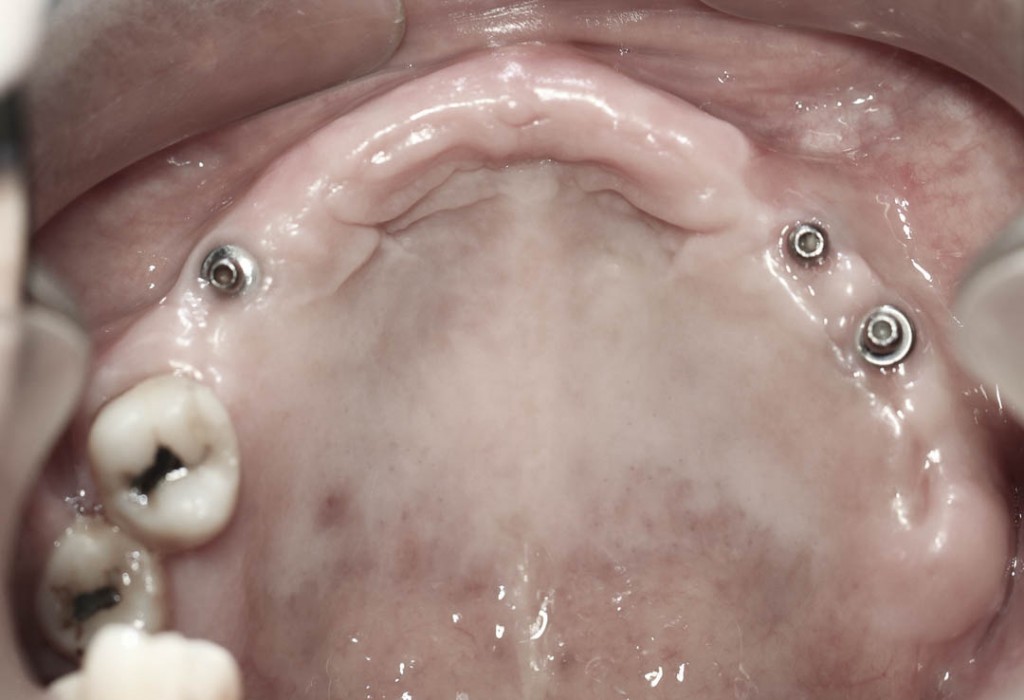 Implant-2-009