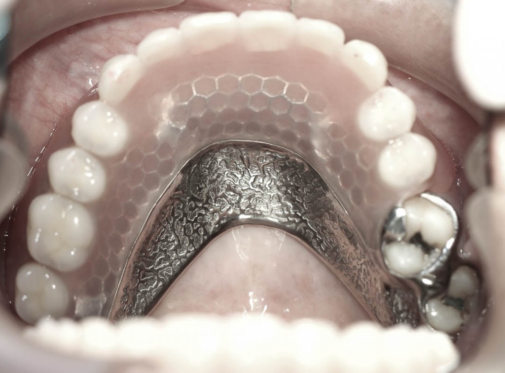 Implant-2-010