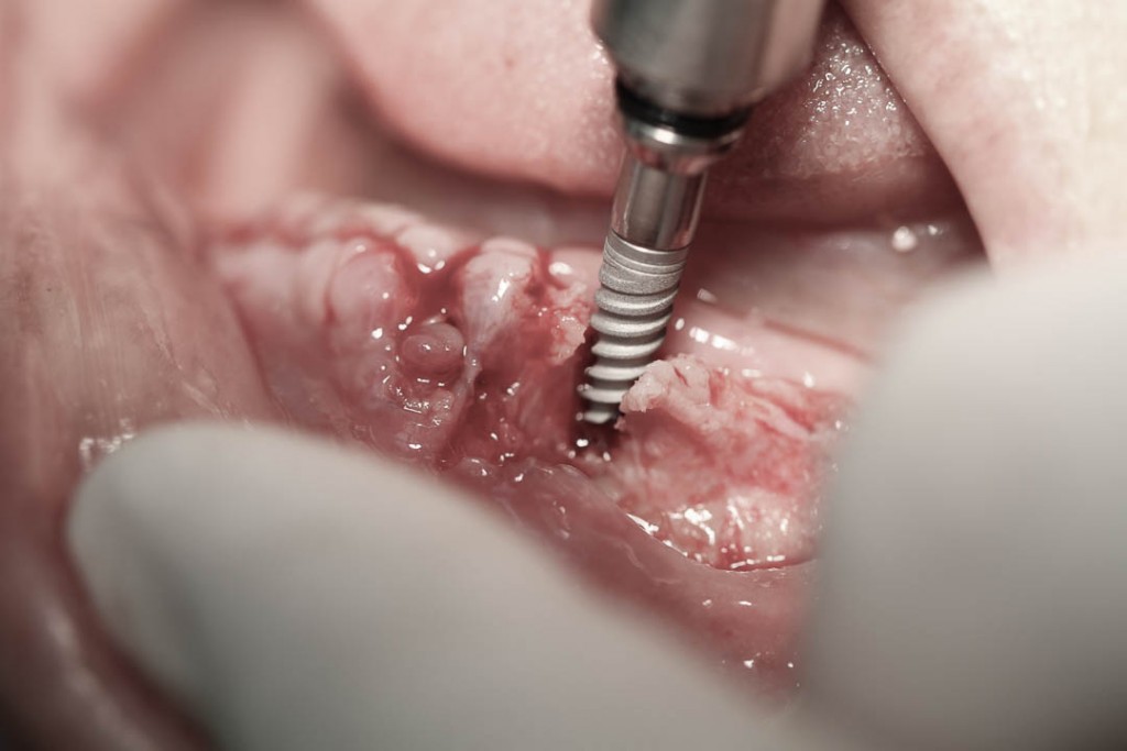 Implant-2-011