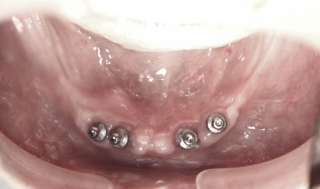 Implant-2-013