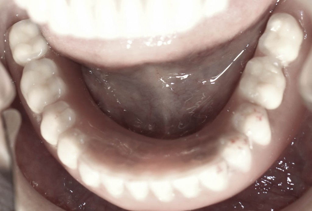 Implant-2-014