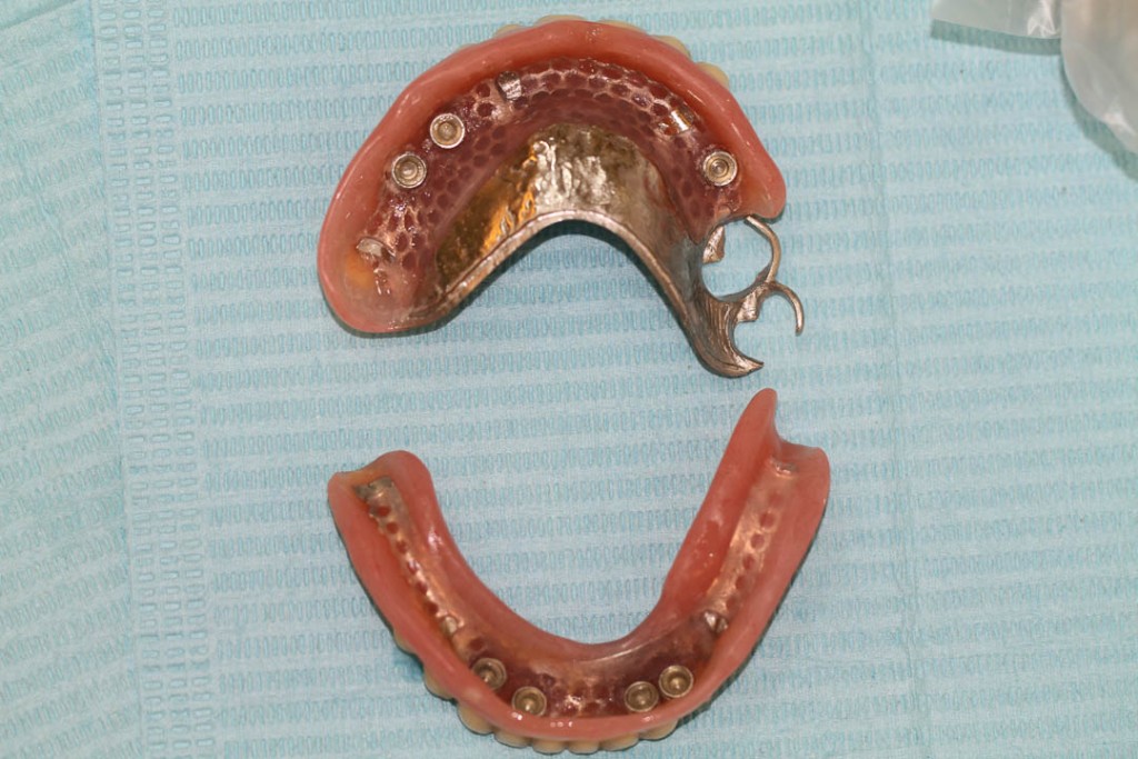 Implant-2-016