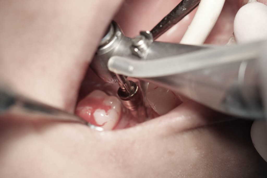 Implant-3-002