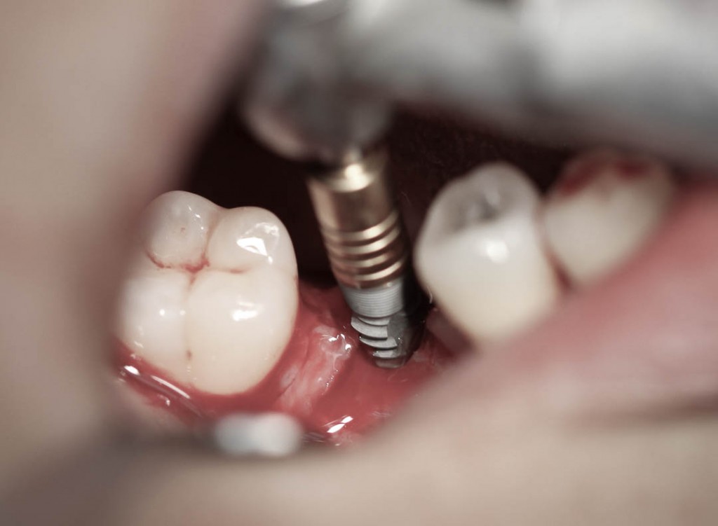 Implant-3-004