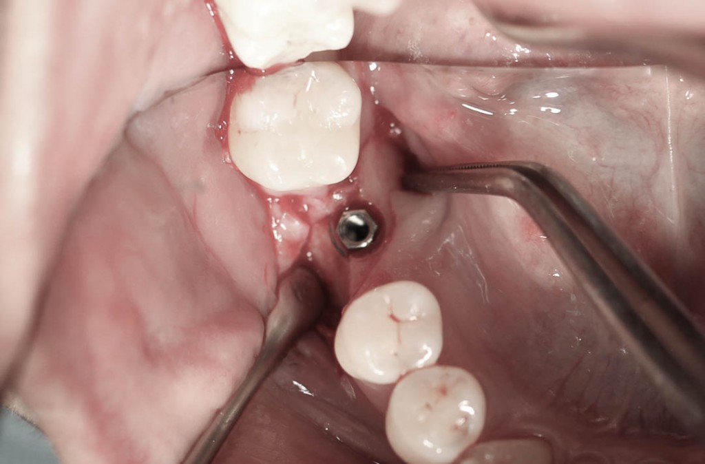 Implant-3-005