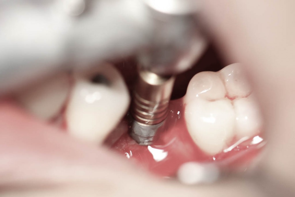 Implant-3-008