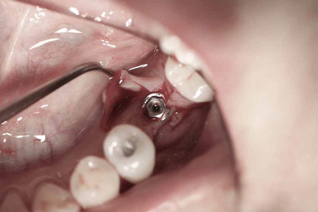 Implant-3-009
