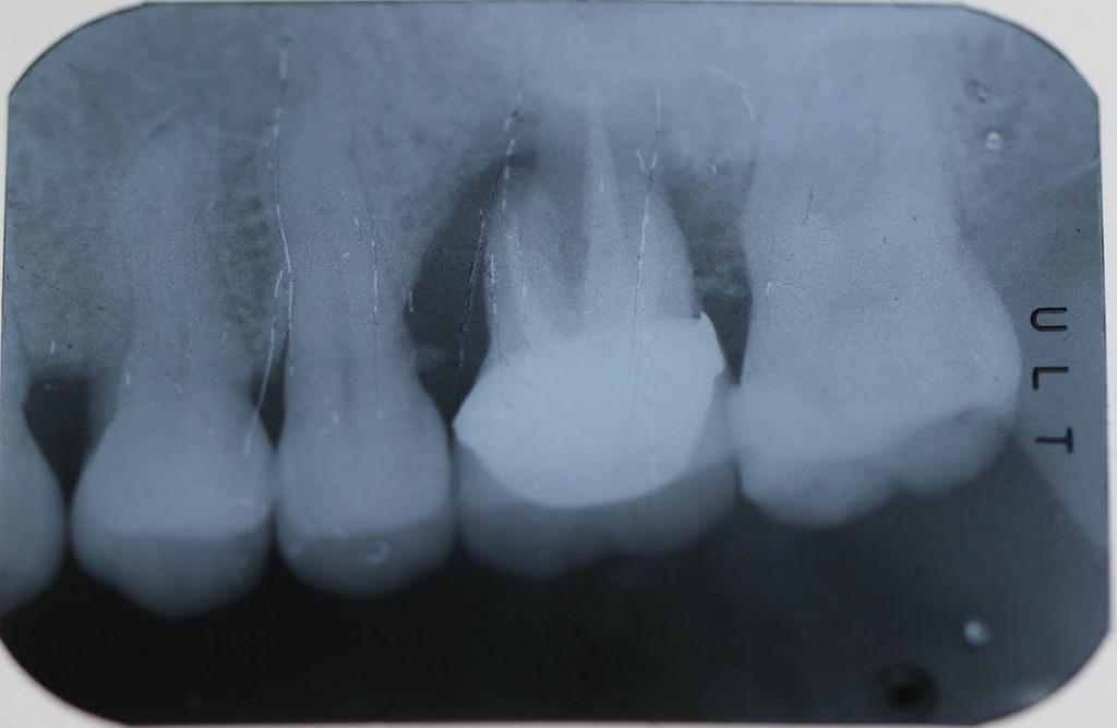 Implant-4-001