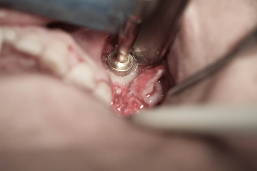 Implant-4-006