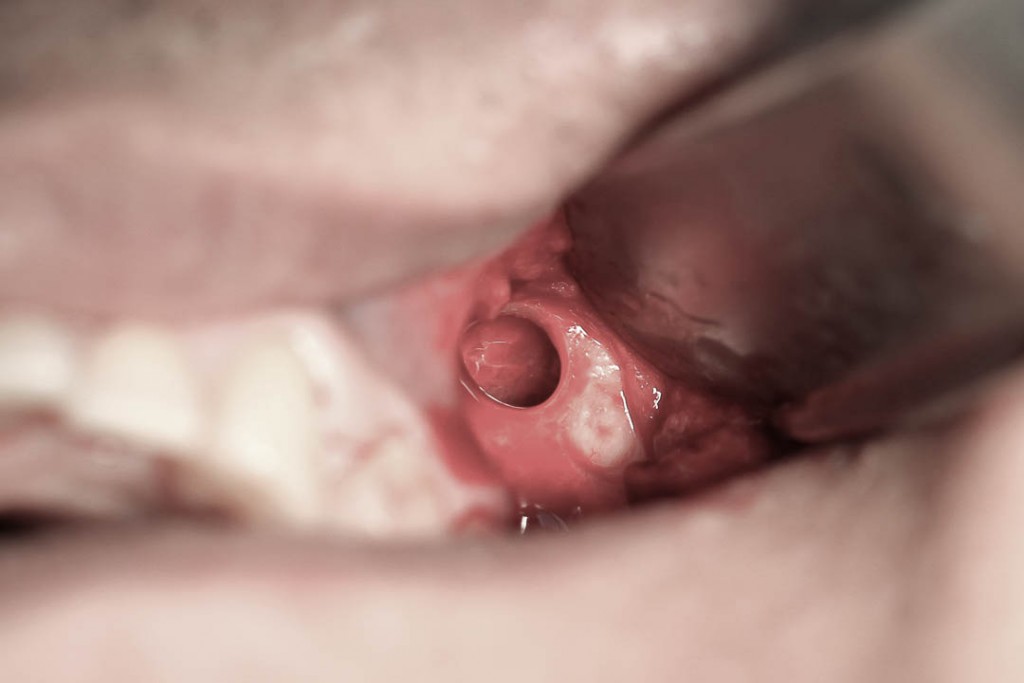 Implant-4-009
