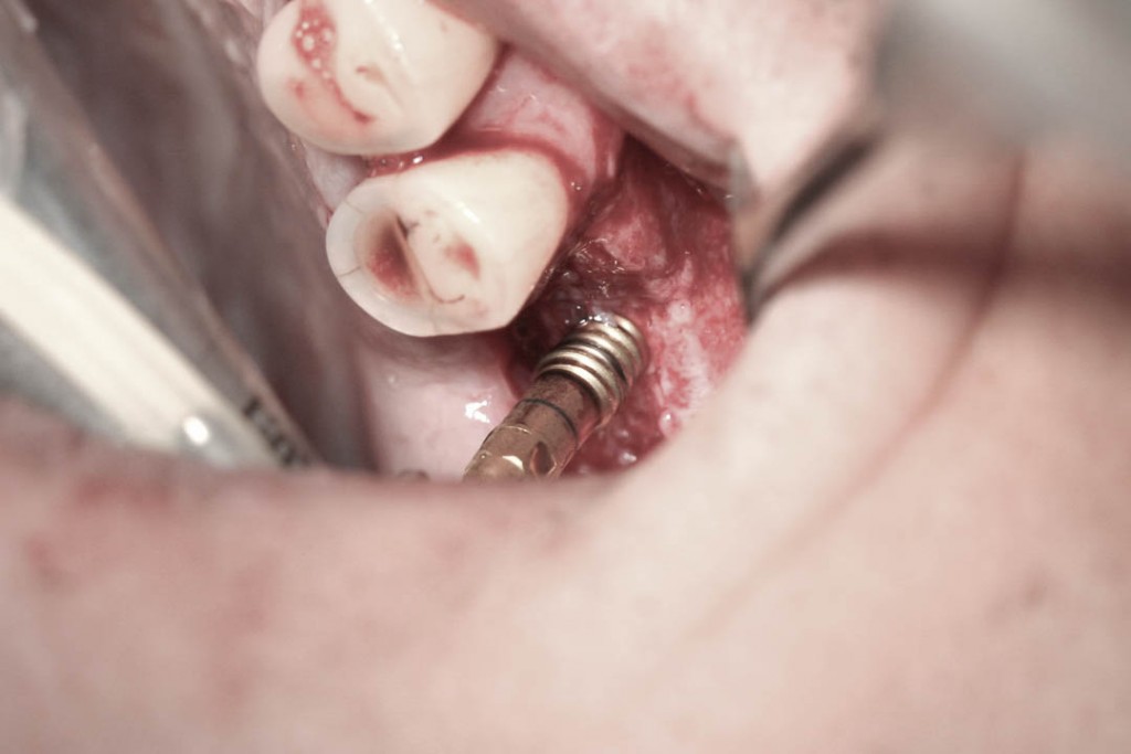 Implant-4-014