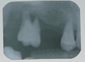Implant-5-004
