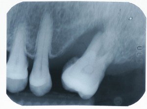 Implant-5-005