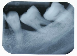 Implant-5-006