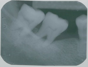 Implant-5-007