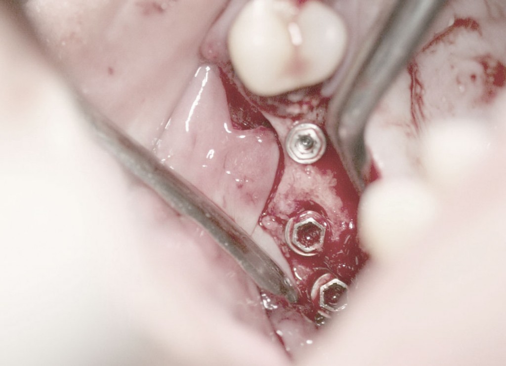 Implant-5-008