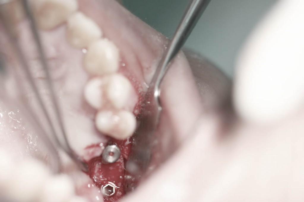 Implant-5-009
