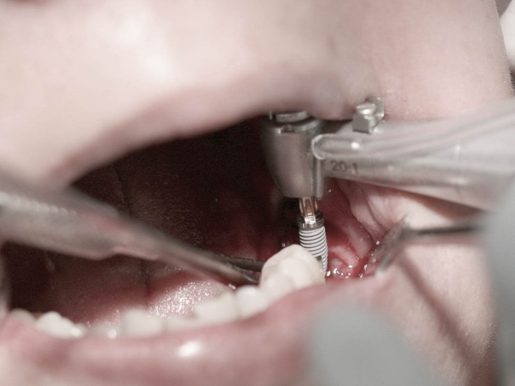 Implant-5-010