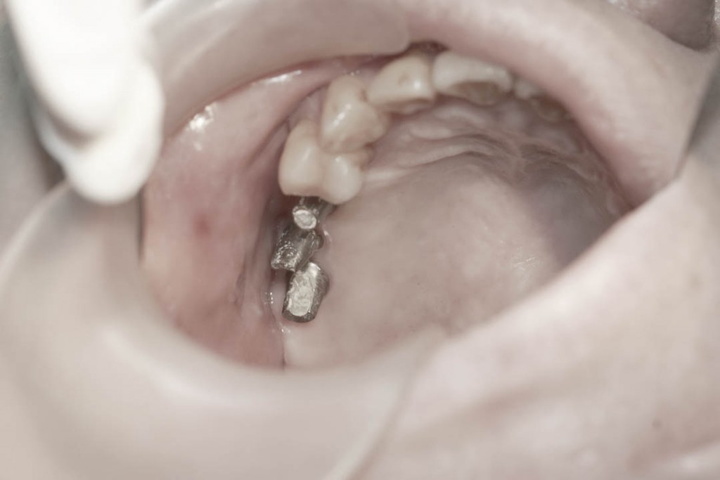 Implant-5-012