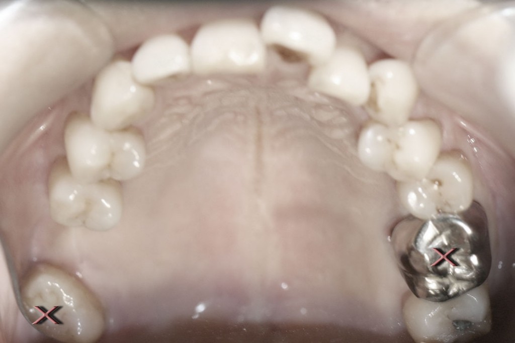 Implant-6-002