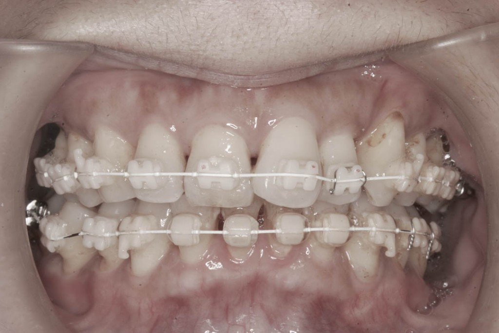 Implant-6-004