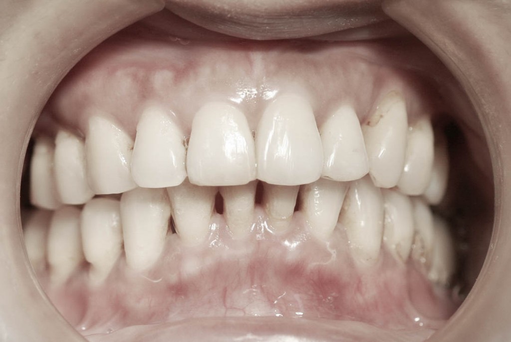Implant-6-005