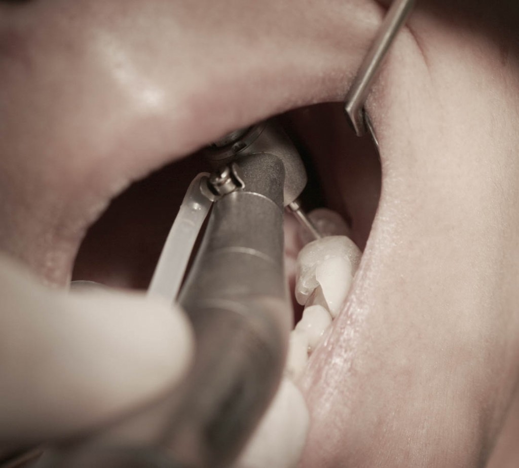 Implant-6-006