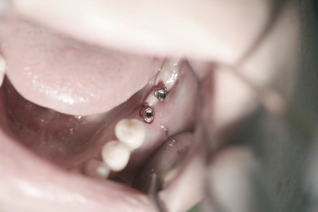 Implant-6-012