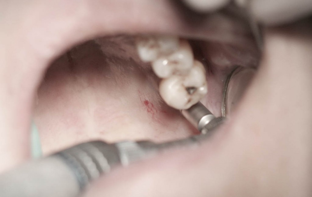 Implant-6-016