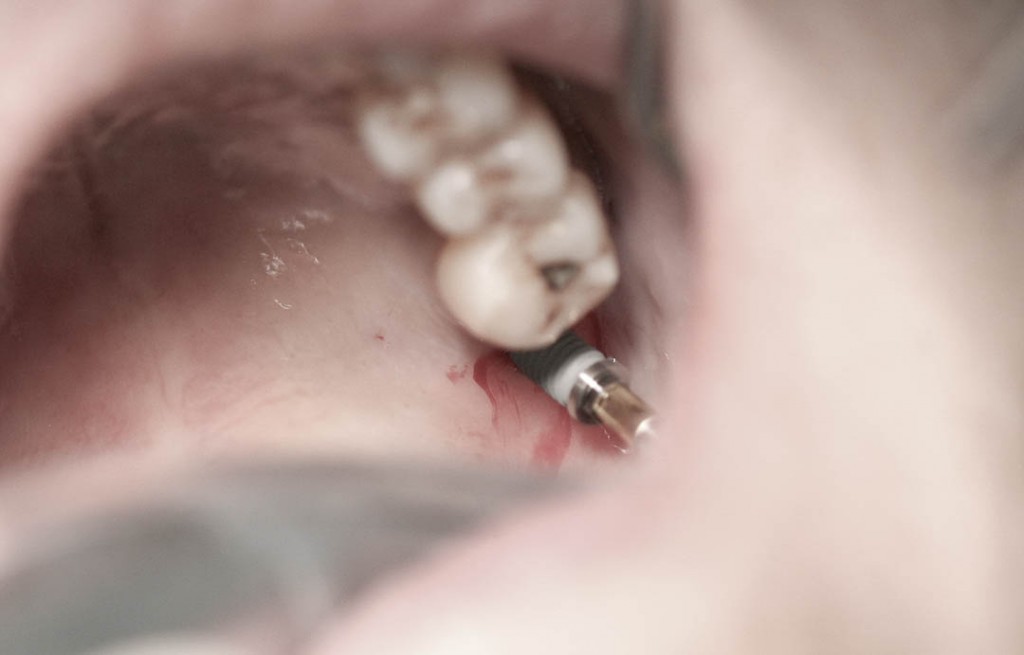 Implant-6-020