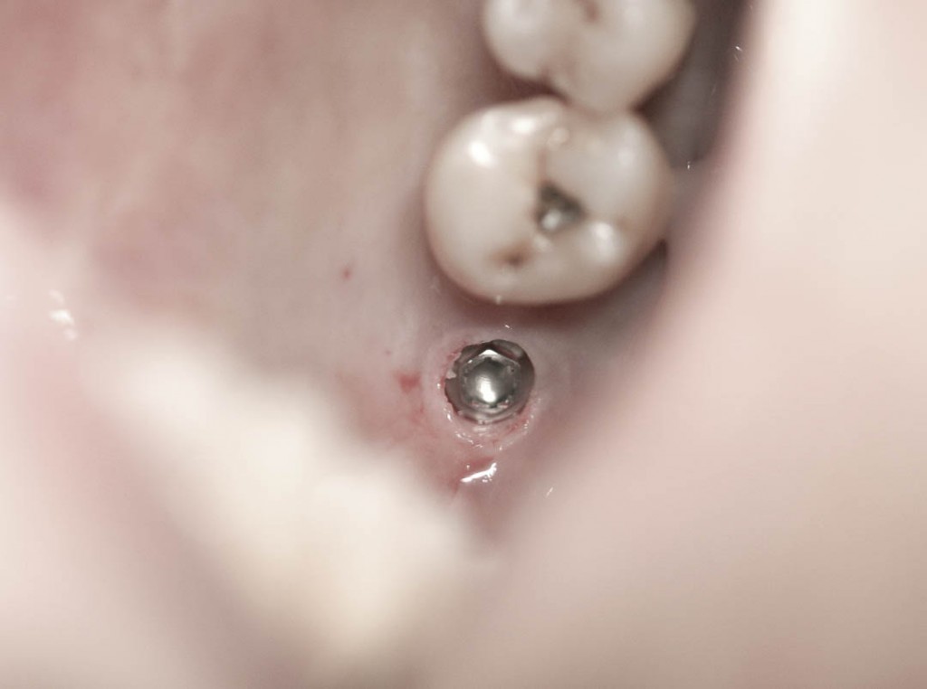 Implant-6-021