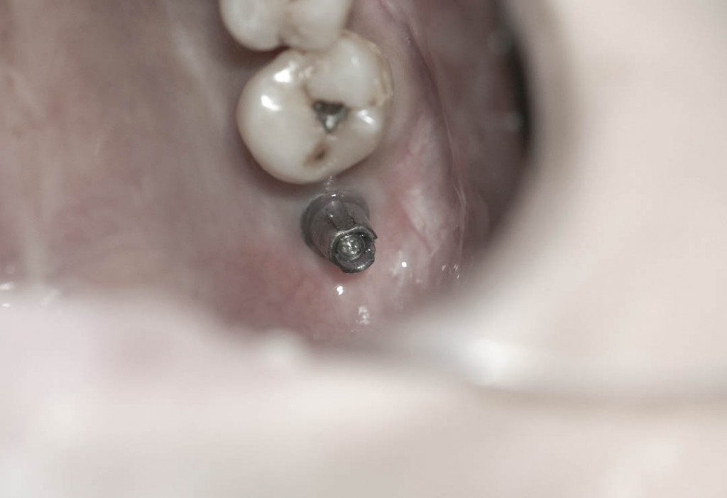 Implant-6-023