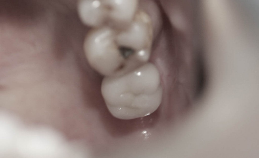 Implant-6-024