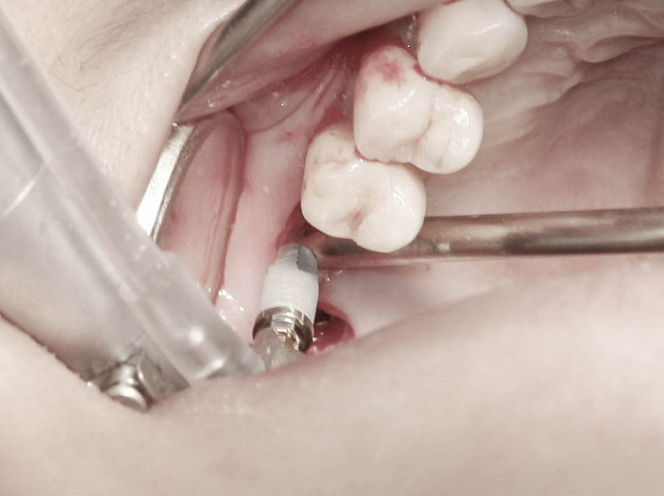 Implant-6-025