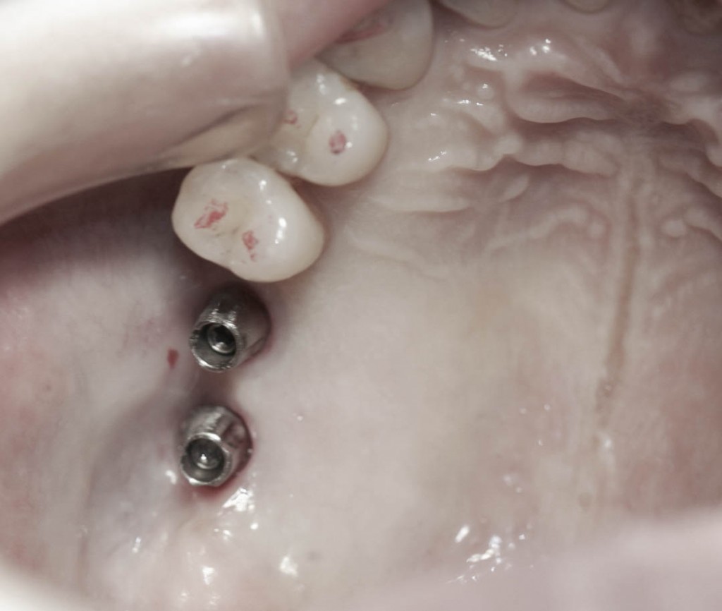 Implant-6-028