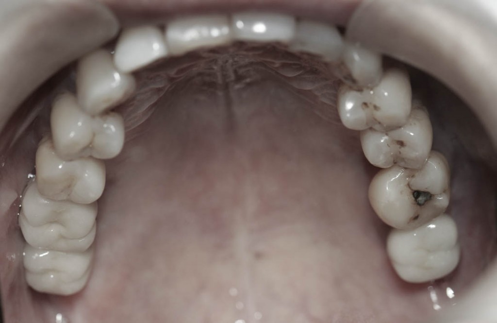 Implant-6-029
