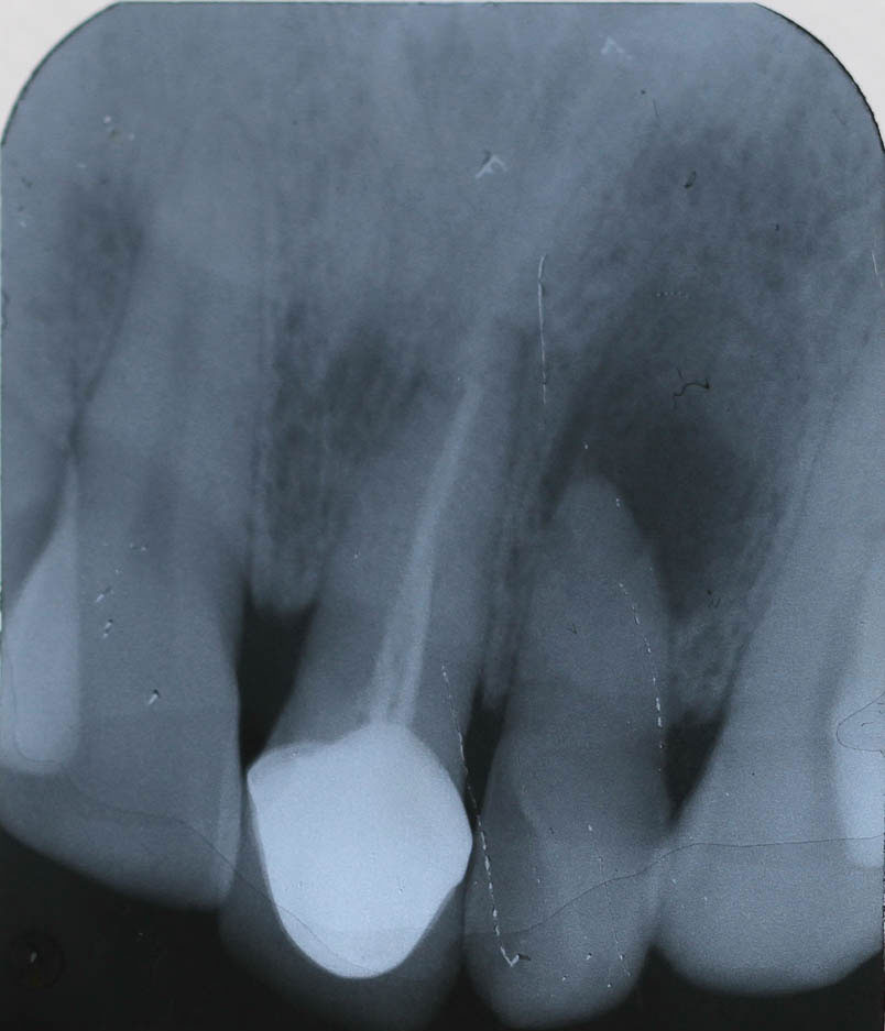 Implant-7-002